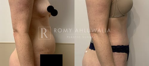 Before & After Result of Tummy Tuck Patient #70