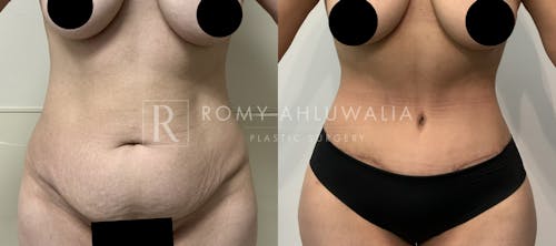 Before & After Result of Tummy Tuck Patient #71