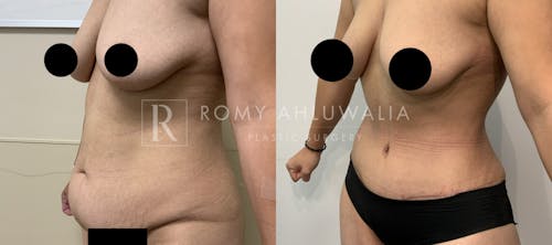 Before & After Result of Tummy Tuck Patient #71