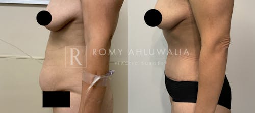 Before & After Result of Tummy Tuck Patient #71
