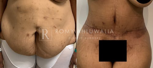 Before & After Result of Tummy Tuck Patient #72