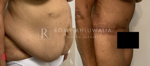 Before & After Result of Tummy Tuck Patient #72