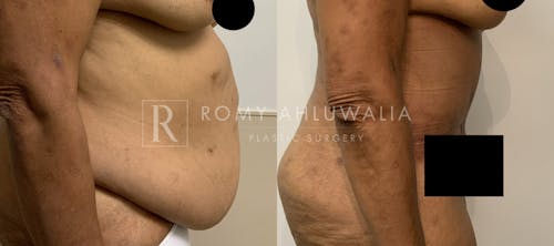 Before & After Result of Tummy Tuck Patient #72