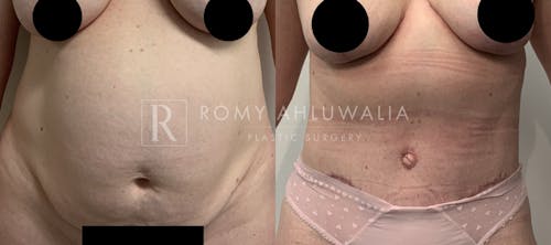 Before & After Result of Tummy Tuck Patient #73