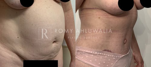 Before & After Result of Tummy Tuck Patient #73