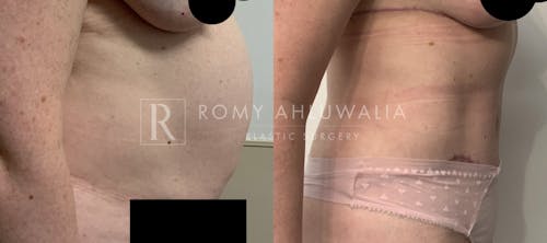 Before & After Result of Tummy Tuck Patient #73