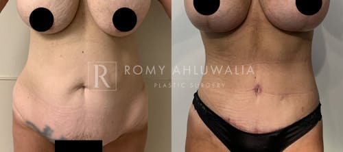 Before & After Result of Tummy Tuck Patient #74