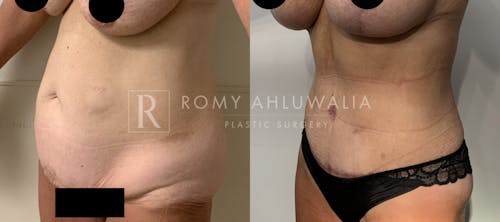 Before & After Result of Tummy Tuck Patient #74