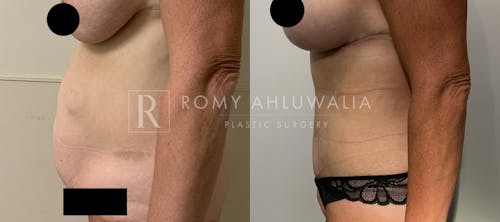 Before & After Result of Tummy Tuck Patient #74