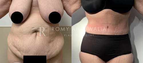 Before & After Result of Tummy Tuck Patient #75