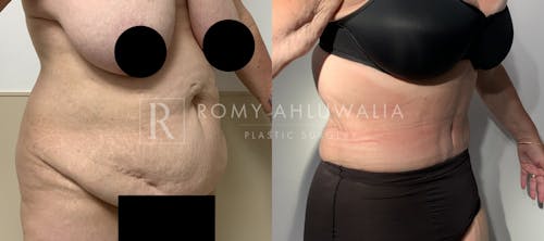 Before & After Result of Tummy Tuck Patient #75