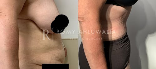 Before & After Result of Tummy Tuck Patient #75