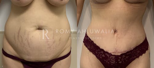 Before & After Result of Tummy Tuck Patient #76