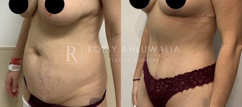 Before & After Result of Tummy Tuck Patient #76