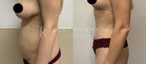 Before & After Result of Tummy Tuck Patient #76