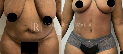 Before & After Result of Tummy Tuck Patient #77
