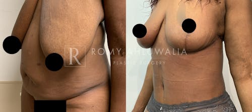 Before & After Result of Tummy Tuck Patient #77