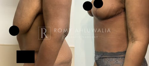Before & After Result of Tummy Tuck Patient #77