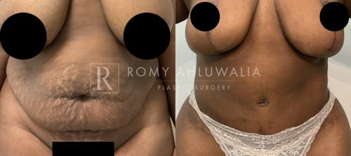 Before & After Result of Tummy Tuck Patient #78