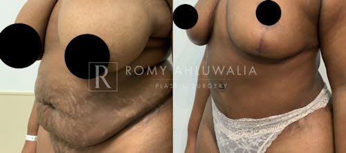 Before & After Result of Tummy Tuck Patient #78