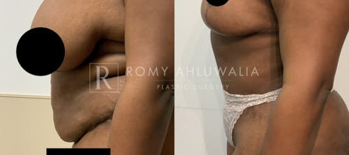Before & After Result of Tummy Tuck Patient #78