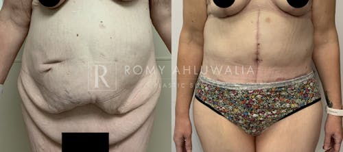 Before & After Result of Tummy Tuck Patient #79