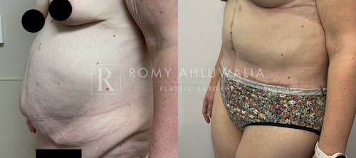 Before & After Result of Tummy Tuck Patient #79