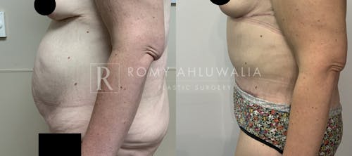 Before & After Result of Tummy Tuck Patient #79