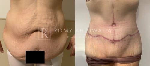 Before & After Result of Tummy Tuck Patient #80