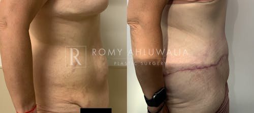 Before & After Result of Tummy Tuck Patient #80