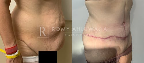 Before & After Result of Tummy Tuck Patient #80