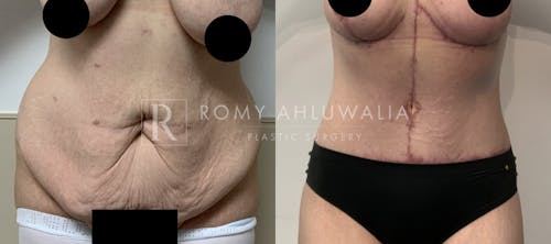 Before & After Result of Tummy Tuck Patient #81