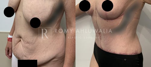 Before & After Result of Tummy Tuck Patient #81