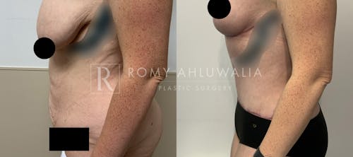 Before & After Result of Tummy Tuck Patient #81