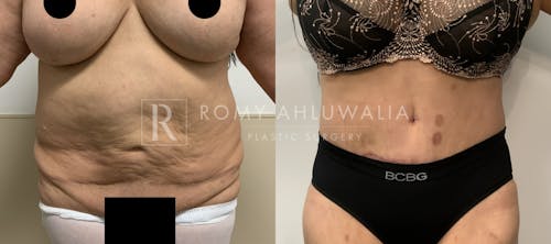 Before & After Result of Tummy Tuck Patient #82