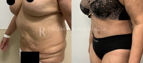 Before & After Result of Tummy Tuck Patient #82
