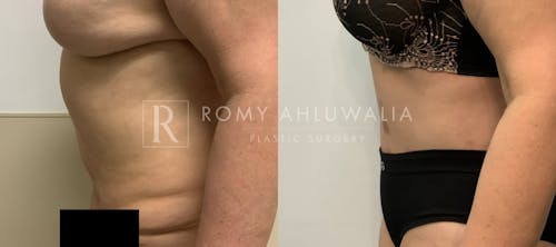 Before & After Result of Tummy Tuck Patient #82
