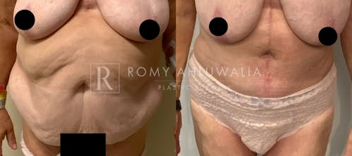 Before & After Result of Tummy Tuck Patient #83