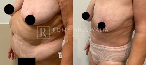 Before & After Result of Tummy Tuck Patient #83