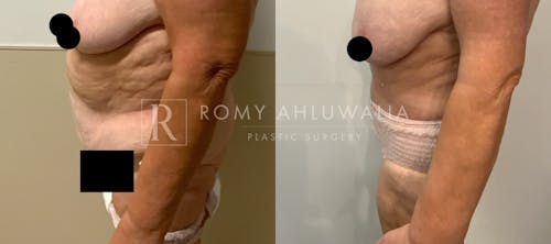 Before & After Result of Tummy Tuck Patient #83