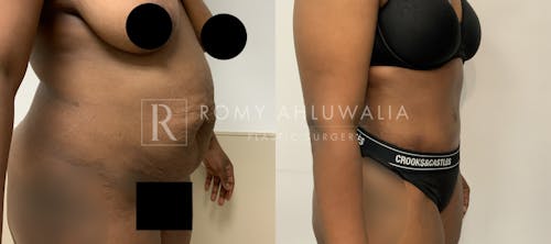 Before & After Result of Tummy Tuck Patient #84