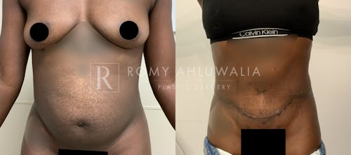 Before & After Result of Tummy Tuck Patient #85
