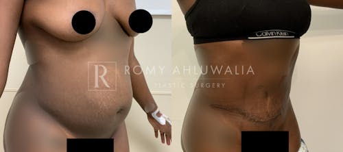 Before & After Result of Tummy Tuck Patient #85