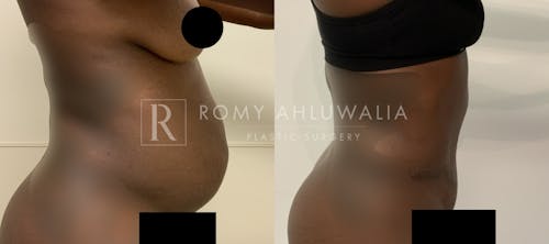 Before & After Result of Tummy Tuck Patient #85
