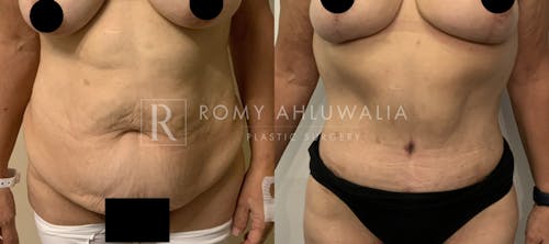 Before & After Result of Tummy Tuck Patient #86