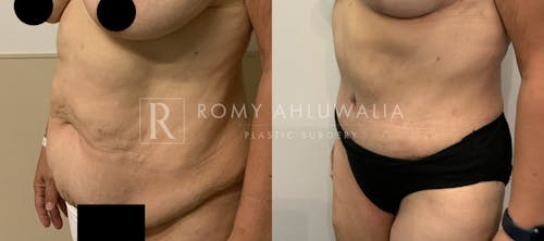 Before & After Result of Tummy Tuck Patient #86