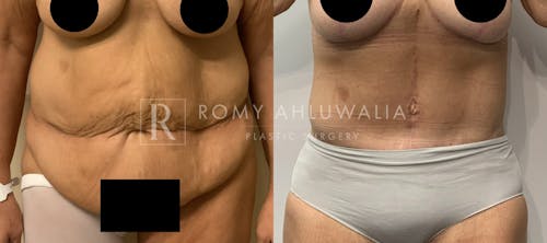Before & After Result of Tummy Tuck Patient #87