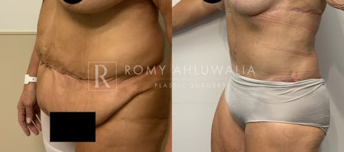 Before & After Result of Tummy Tuck Patient #87