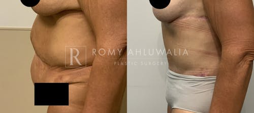 Before & After Result of Tummy Tuck Patient #87