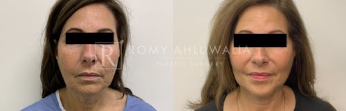 Before & After Result of Mini Facelift Patient #27